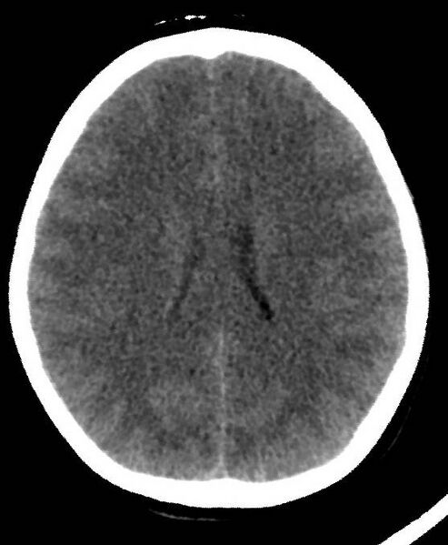 File:Cerebral edema due to severe hyponatremia (Radiopaedia 89826-106937 Axial non-contrast 56).jpg