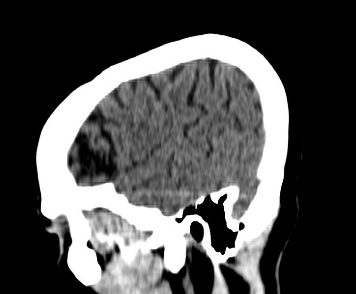 File:Cerebral venous thrombosis - CT only (Radiopaedia 41031-43778 B 3).jpg