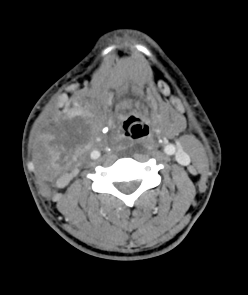 File:Cervical abscess (Radiopaedia 43725-47184 A 34).png