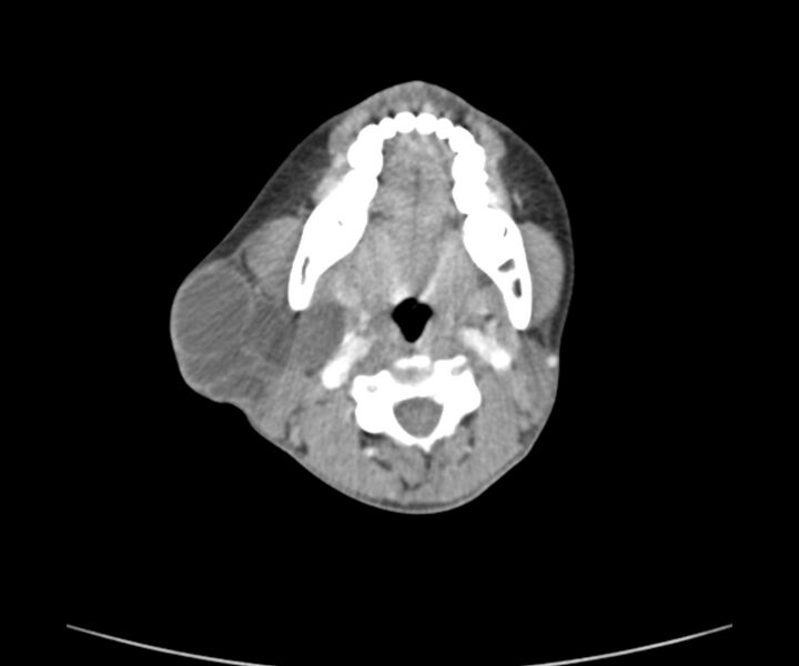 File:Cervical cystic lymphangioma (Radiopaedia 63655-72332 Axial + contrast 12).jpg