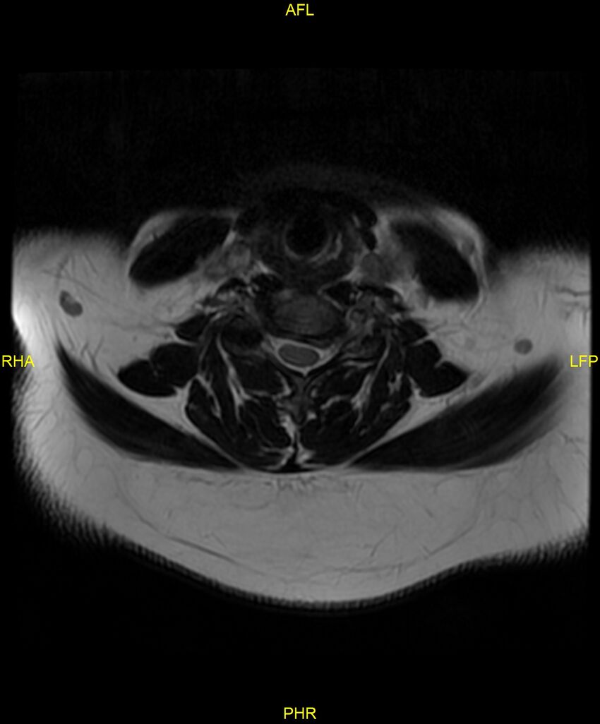 Cervical disc protrusion (Radiopaedia 87147-103415 Axial T2 33).jpg