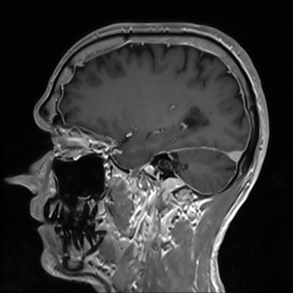 File:Cervical dural CSF leak on MRI and CT treated by blood patch (Radiopaedia 49748-54995 G 31).jpg
