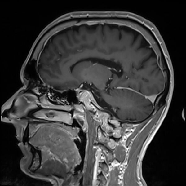 File:Cervical dural CSF leak on MRI and CT treated by blood patch (Radiopaedia 49748-54995 G 44).jpg