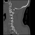 Cervical flexion teardrop fracture with cord hemorrhage (Radiopaedia 32497-33454 Sagittal bone window 15).jpg