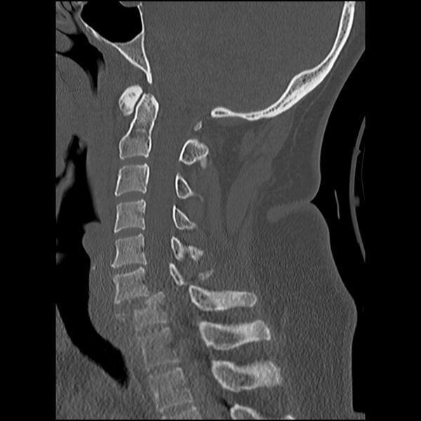 File:Cervical fracture and dislocation with locked facet (Radiopaedia 31837-32780 Sagittal bone window 16).jpg