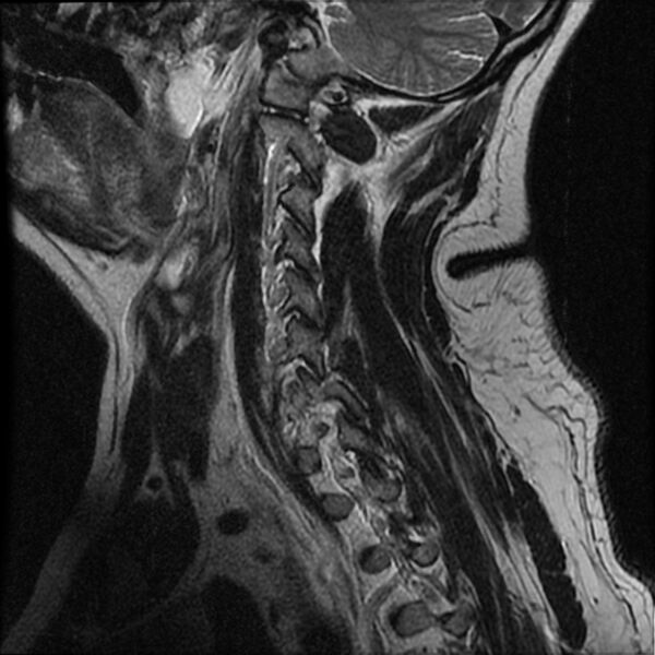 File:Cervical fracture and dislocation with locked facet (Radiopaedia 31837-32781 Sagittal T2 14).jpg