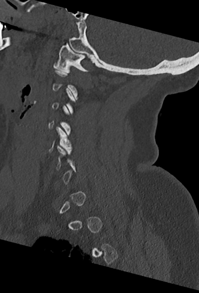 File:Cervical spine ACDF loosening (Radiopaedia 48998-54070 Sagittal bone window 29).png
