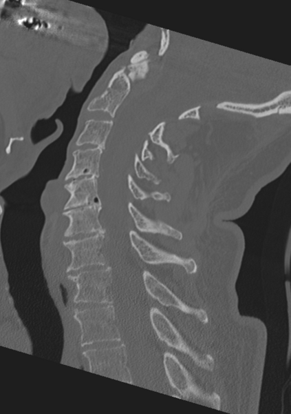 File:Cervical spine fractures with vertebral artery dissection (Radiopaedia 53296-59268 Sagittal bone window 32).png