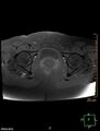 Cesarian scar endometriosis (Radiopaedia 68495-78066 Axial T1 fat sat 20).jpg