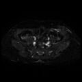 Cesarian section scar endometriosis (Radiopaedia 66520-75799 Axial DWI 4).jpg