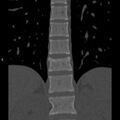 Chance fracture (Radiopaedia 36521-38081 Coronal bone window 15).jpg