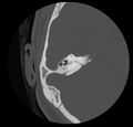 Cholesteatoma (Radiopaedia 20296-20217 bone window 35).jpg