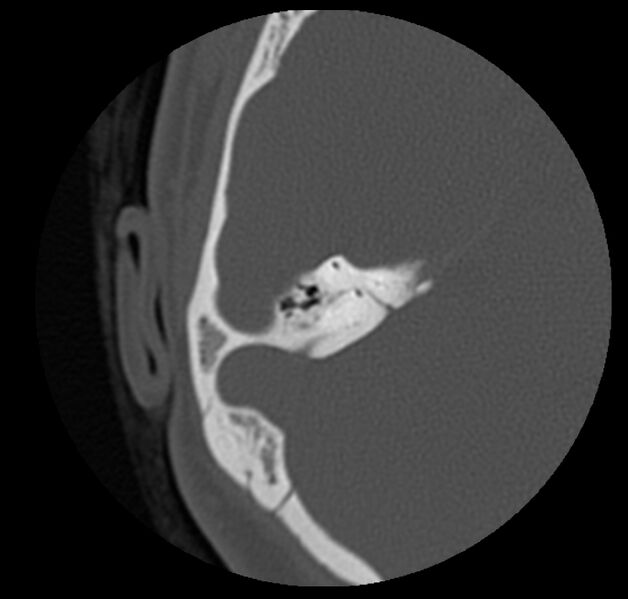 File:Cholesteatoma (Radiopaedia 20296-20217 bone window 35).jpg