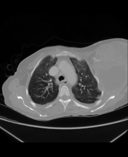 File:Chondrosarcoma (Radiopaedia 79427-92535 Axial lung window 15).jpg
