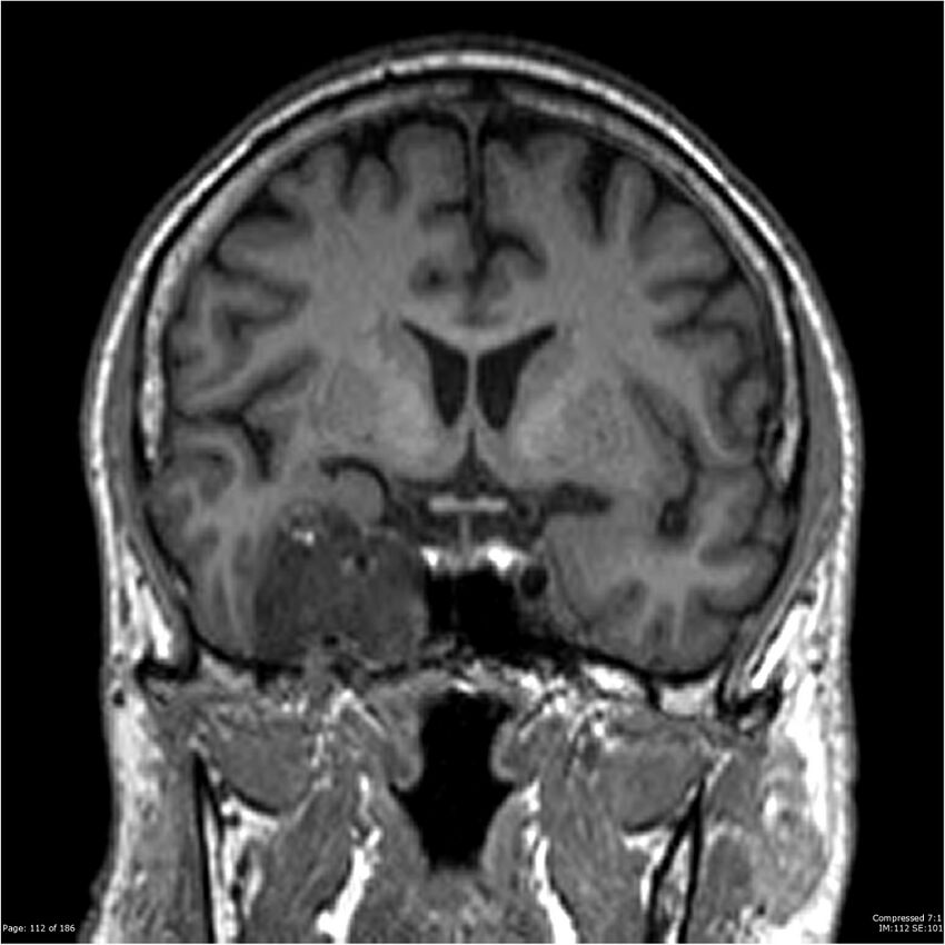 Chondrosarcoma of skull base- grade II (Radiopaedia 40948-43654 Coronal T1 33).jpg