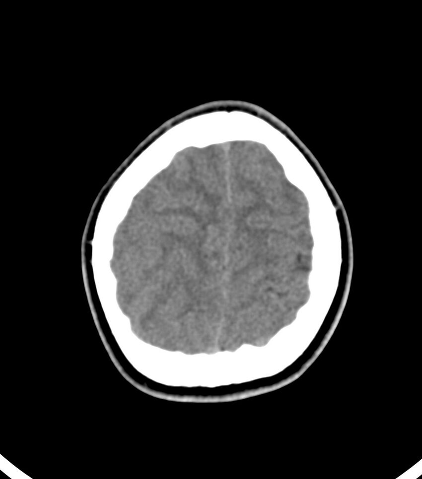 Choroid plexus carcinoma (Radiopaedia 91013-108552 Axial non-contrast 52).jpg