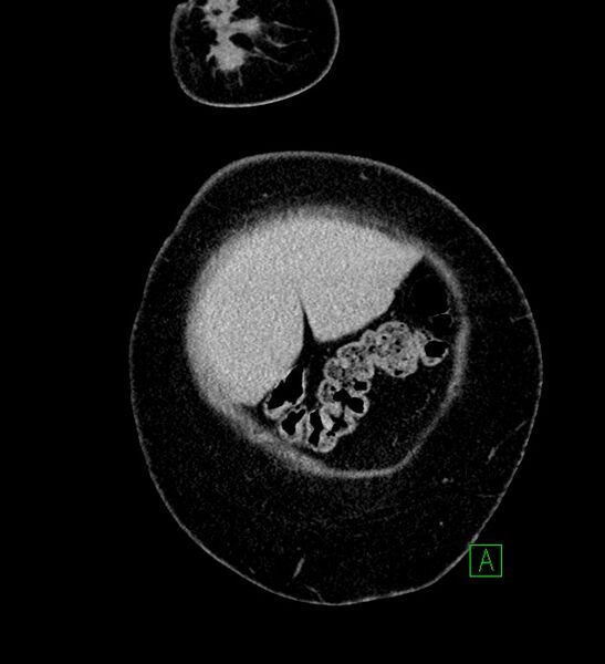 File:Chromophobe renal cell carcinoma (Radiopaedia 84239-99519 F 8).jpg