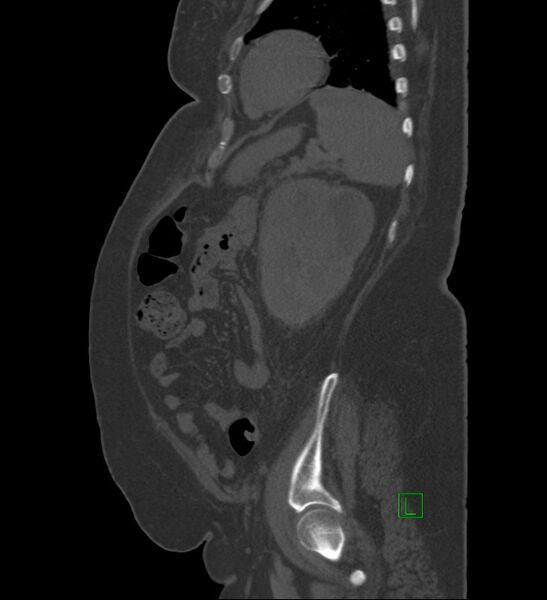 File:Chromophobe renal cell carcinoma (Radiopaedia 84239-99519 Sagittal bone window 24).jpg