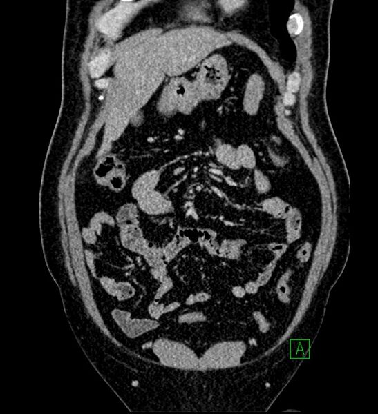 File:Chromophobe renal cell carcinoma (Radiopaedia 84286-99573 H 46).jpg