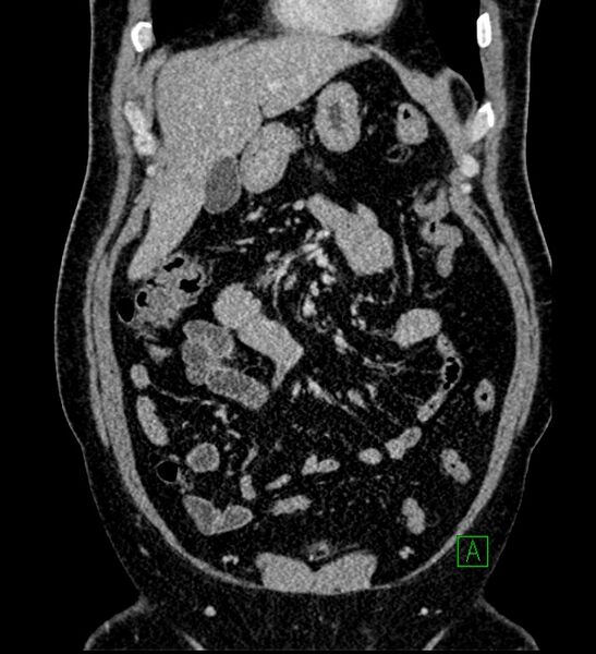 File:Chromophobe renal cell carcinoma (Radiopaedia 84286-99573 H 53).jpg