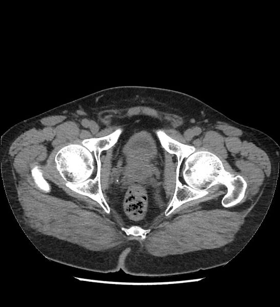 File:Chromophobe renal cell carcinoma (Radiopaedia 86879-103083 Axial non-contrast 127).jpg