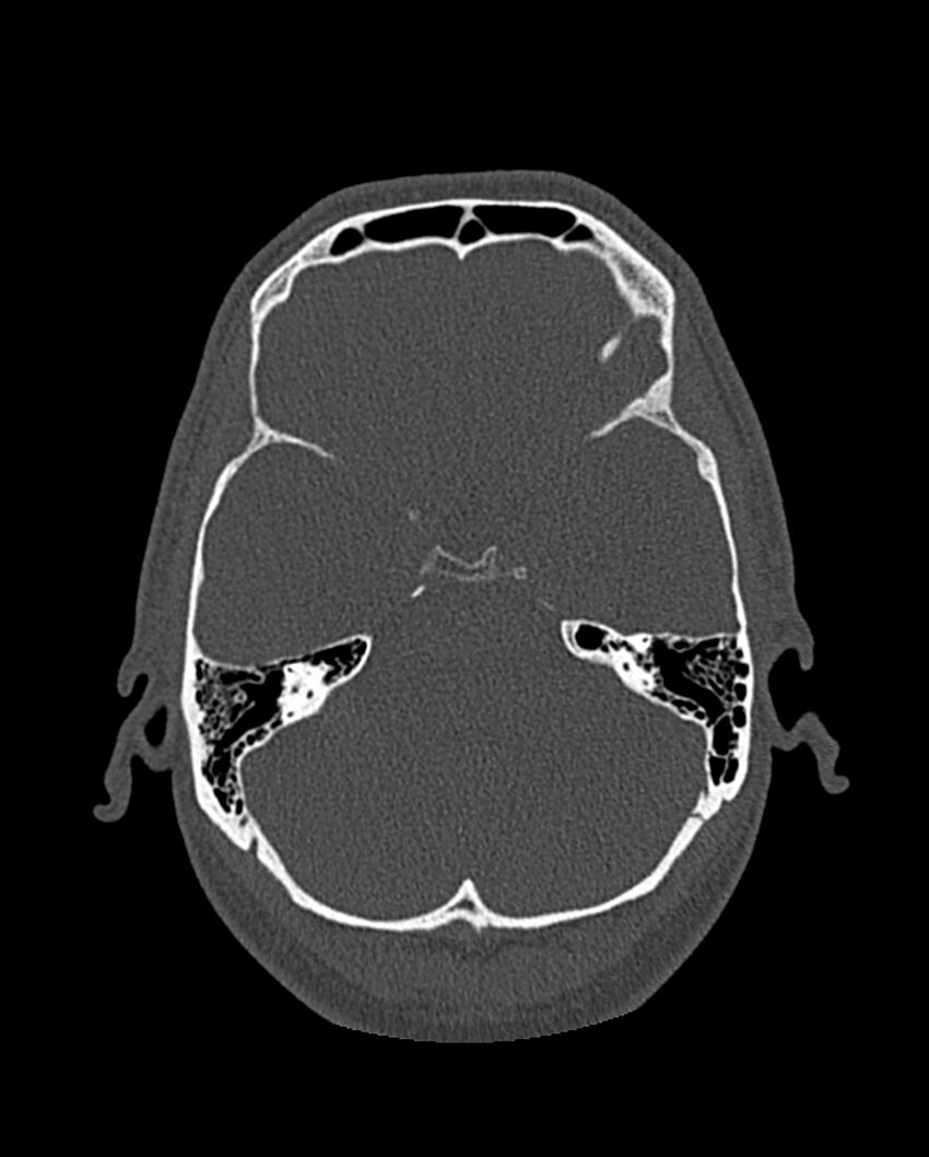 Chronic maxillary sinusitis caused by a foreign body (Radiopaedia 58521-65676 Axial bone window 272).jpg