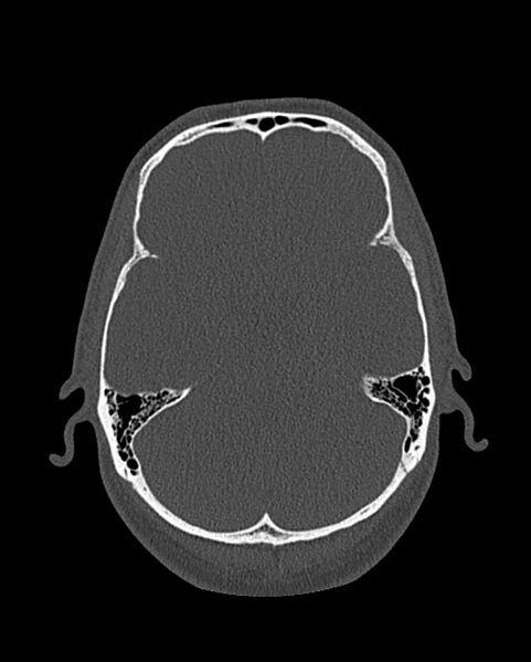 File:Chronic maxillary sinusitis caused by a foreign body (Radiopaedia 58521-65676 Axial bone window 293).jpg