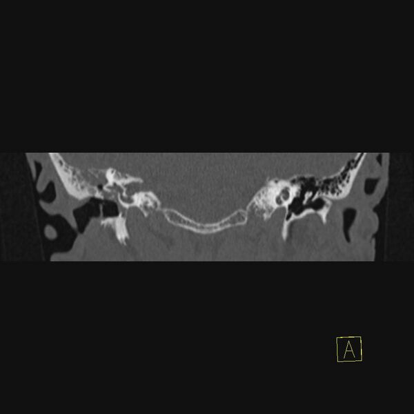 File:Chronic otitis media (Radiopaedia 14994-14912 Coronal bone window 10).JPEG