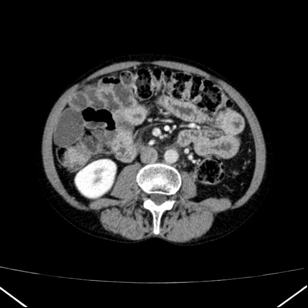 File:Chronic pancreatitis (Radiopaedia 23132-23172 B 33).jpg