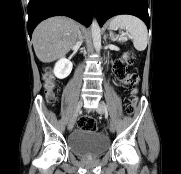 File:Chronic pancreatitis (Radiopaedia 23132-23172 C 35).jpg