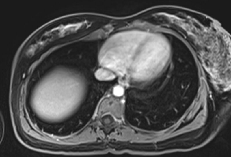 File:Chronic pancreatitis - pancreatic duct calculi (Radiopaedia 71818-82250 Axial T1 C+ fat sat 1).jpg