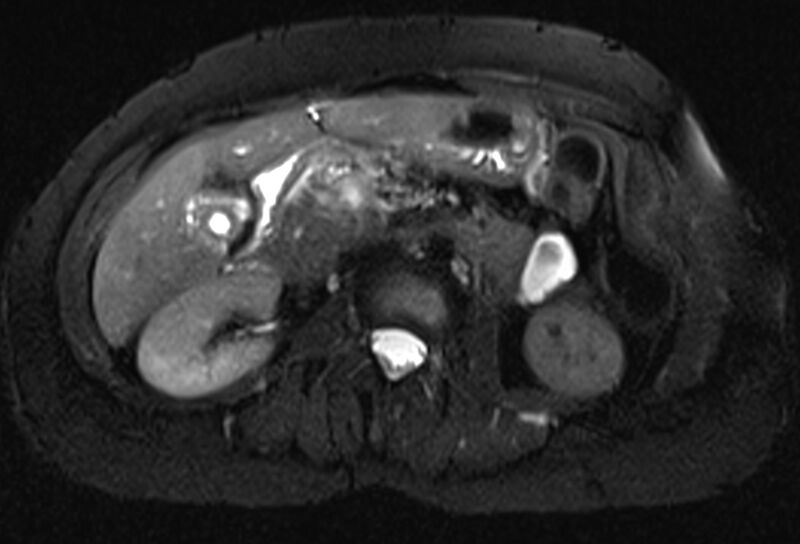 File:Chronic pancreatitis - pancreatic duct calculi (Radiopaedia 71818-82250 Axial T2 fat sat 35).jpg