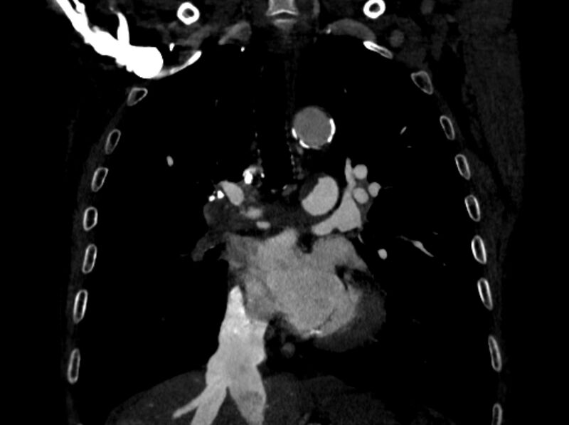 File:Chronic pulmonary embolism (Radiopaedia 91241-108843 A 53).jpg