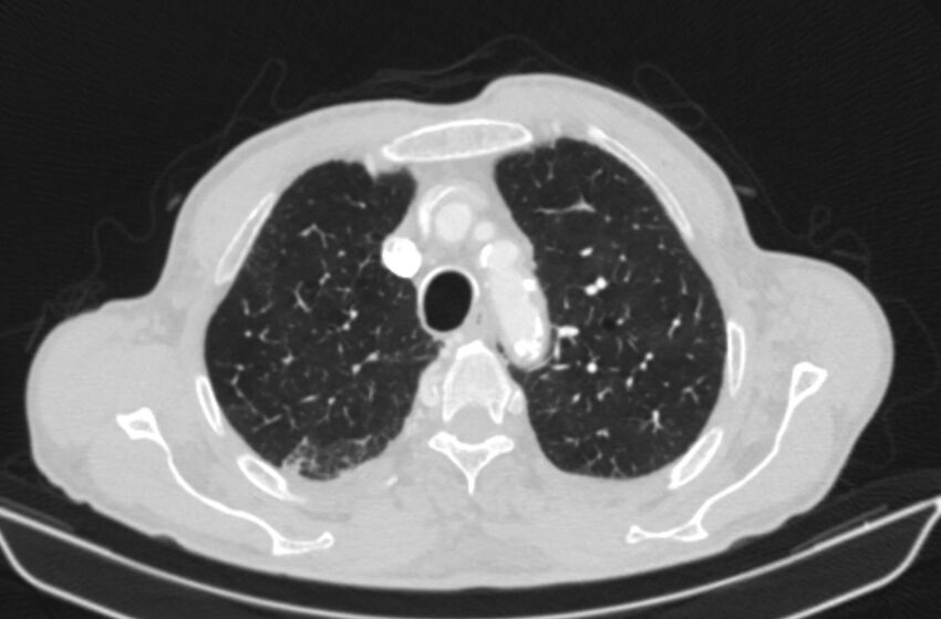 Chronic pulmonary embolism (Radiopaedia 91241-108843 Axial lung window 19).jpg