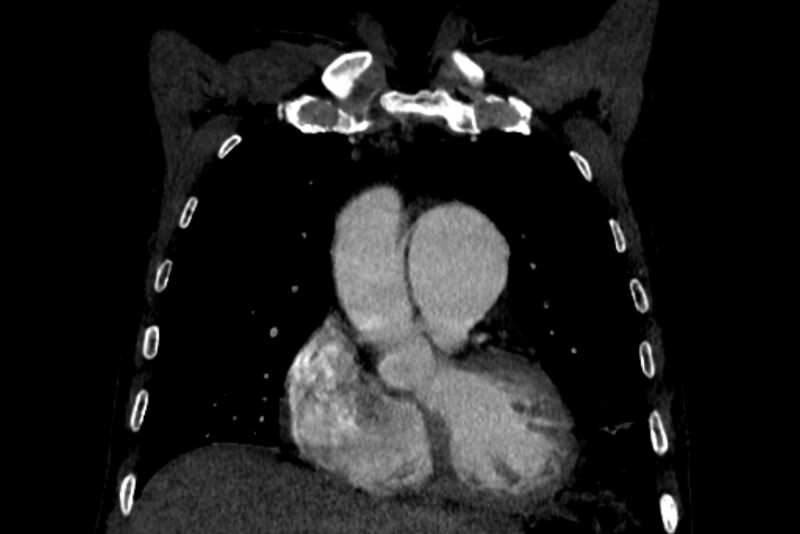 File:Chronic pulmonary embolism with bubbly consolidation (Radiopaedia 91248-108850 B 43).jpg
