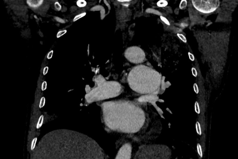File:Chronic pulmonary embolism with bubbly consolidation (Radiopaedia 91248-108850 B 77).jpg