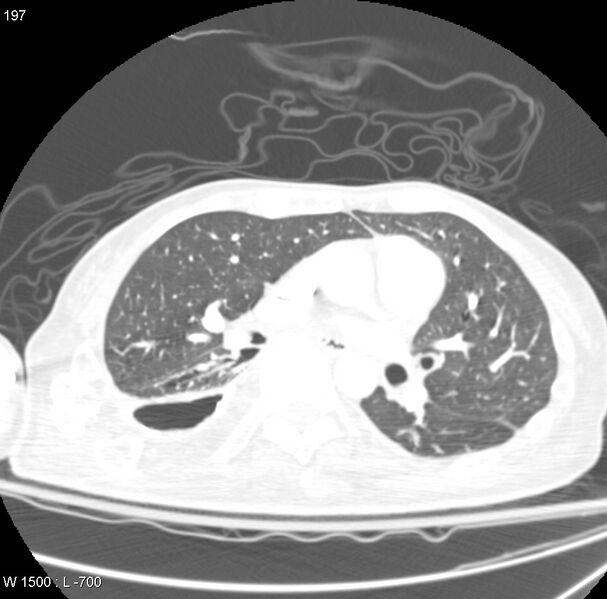 File:Clagett thoracotomy (Radiopaedia 8568-9403 Axial lung window 10).jpg