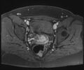 Class II Mullerian duct anomaly- unicornuate uterus with rudimentary horn and non-communicating cavity (Radiopaedia 39441-41755 Axial T1 fat sat 83).jpg