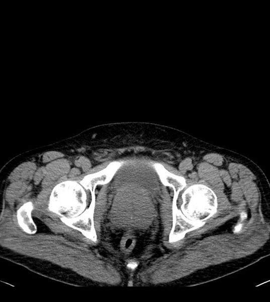 File:Clear cell renal cell carcinoma (Radiopaedia 85006-100539 Axial non-contrast 85).jpg