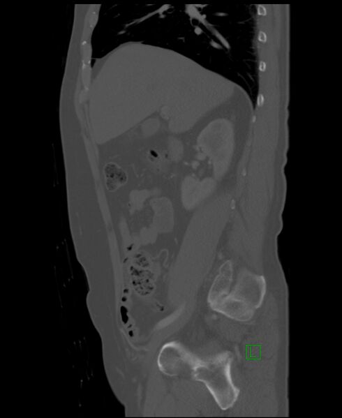 File:Clear cell renal cell carcinoma (Radiopaedia 85006-100539 Sagittal bone window 41).jpg