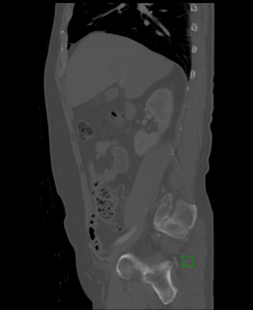 Clear cell renal cell carcinoma (Radiopaedia 85006-100539 Sagittal bone window 41).jpg