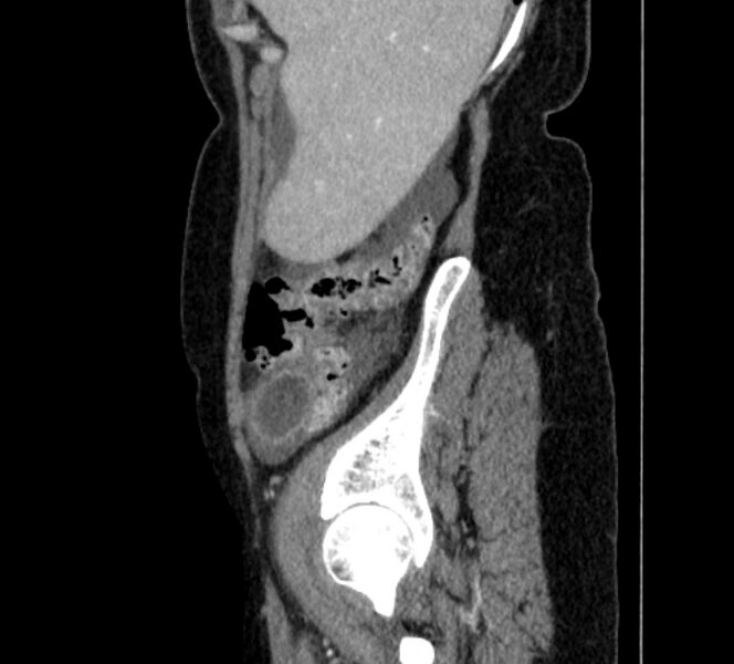 File:Closed loop small bowel obstruction (Radiopaedia 71211-81508 C 6).jpg
