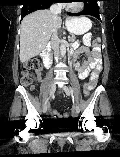 File:Closed loop small bowel obstruction - adhesions (Radiopaedia 59078-66369 B 64).jpg