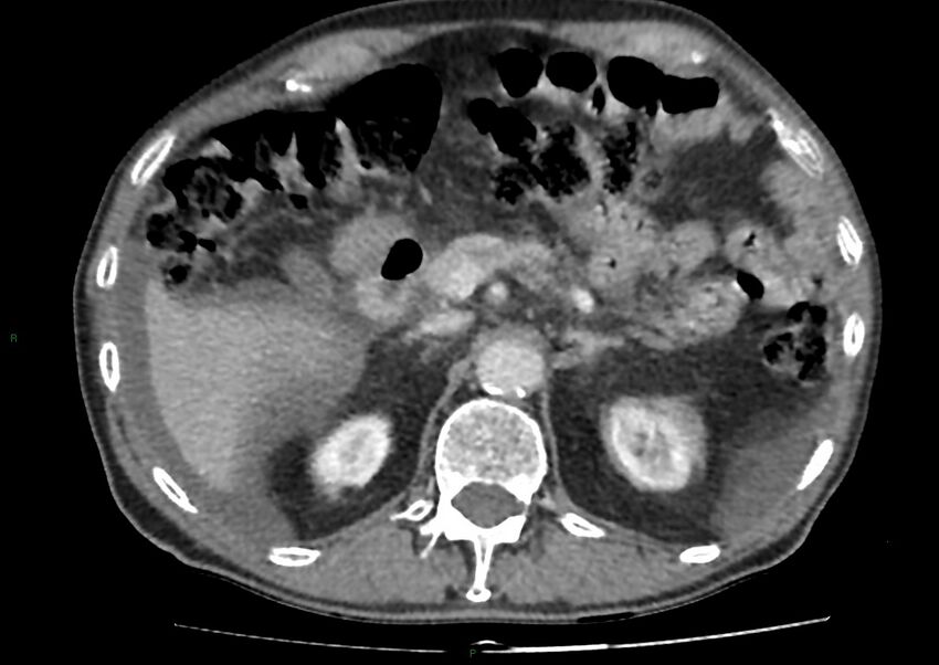 Closed loop small bowel obstruction with ischemia (Radiopaedia 84180-99456 A 34).jpg