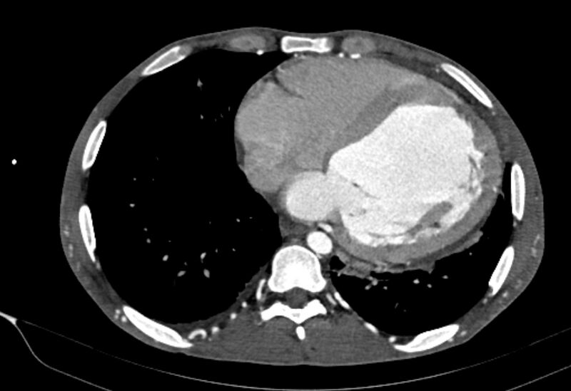 File:Coarctation of aorta with aortic valve stenosis (Radiopaedia 70463-80574 A 154).jpg