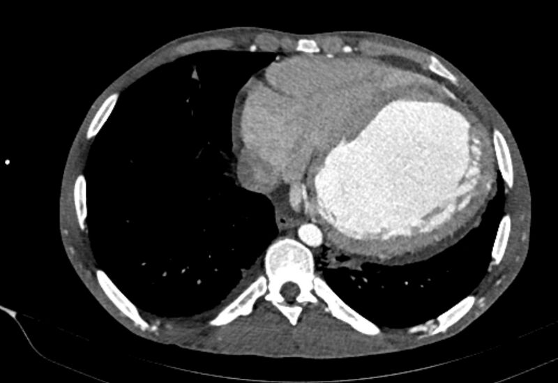 File:Coarctation of aorta with aortic valve stenosis (Radiopaedia 70463-80574 A 165).jpg
