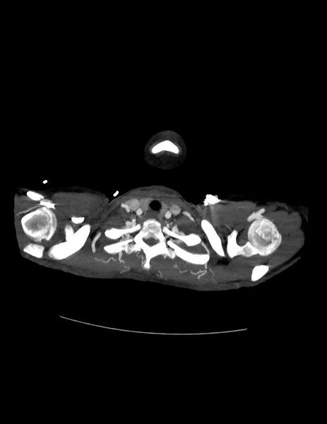 File:Coarctation of the aorta (Radiopaedia 27458-27657 D 2).jpg