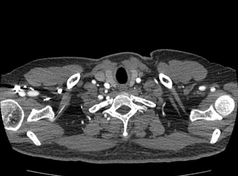 File:Coarctation of the aorta (Radiopaedia 53363-59343 A 6).jpg
