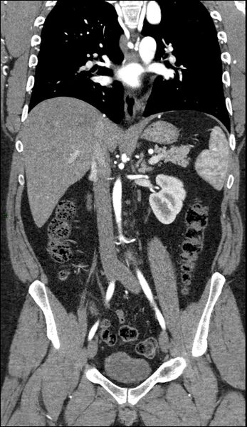 File:Coarctation of the aorta (Radiopaedia 74632-88521 B 129).jpg