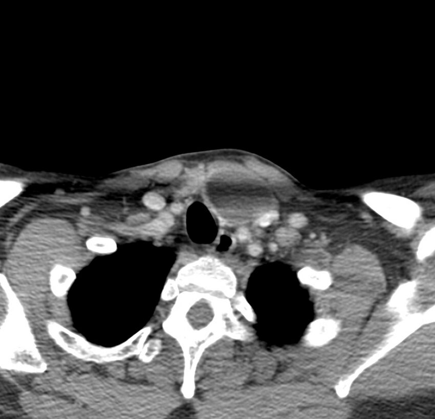 Colloid cyst of thyroid (Radiopaedia 22897-22923 Axial C+ delayed 68).jpg
